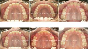 習慣性の口呼吸の患者さん Album 165 石井歯科矯正歯科医院