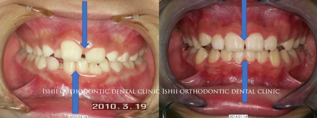 下顎が右に3ミリほどずれている小児 Album 174 石井歯科矯正歯科医院