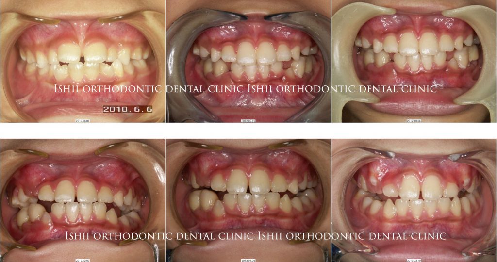 反対咬合の小児の1期治療 album 171 | 石井歯科矯正歯科医院