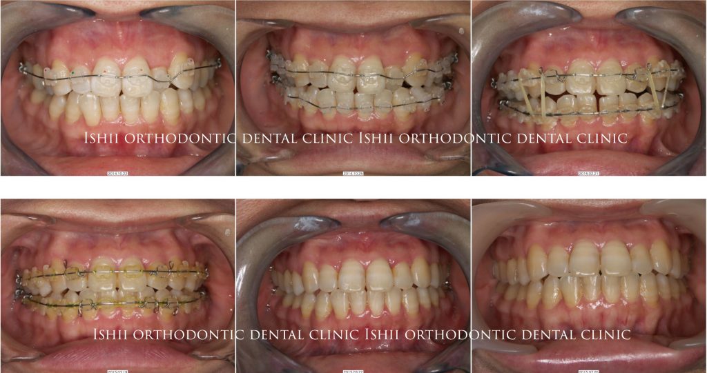 左上の前歯が凹んでいて歯が無いように見える Album 180 石井歯科矯正歯科医院