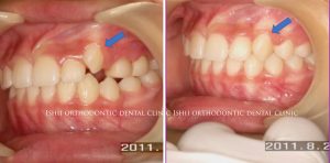 八重歯を簡単に治す方法について Album 199 石井歯科矯正歯科医院