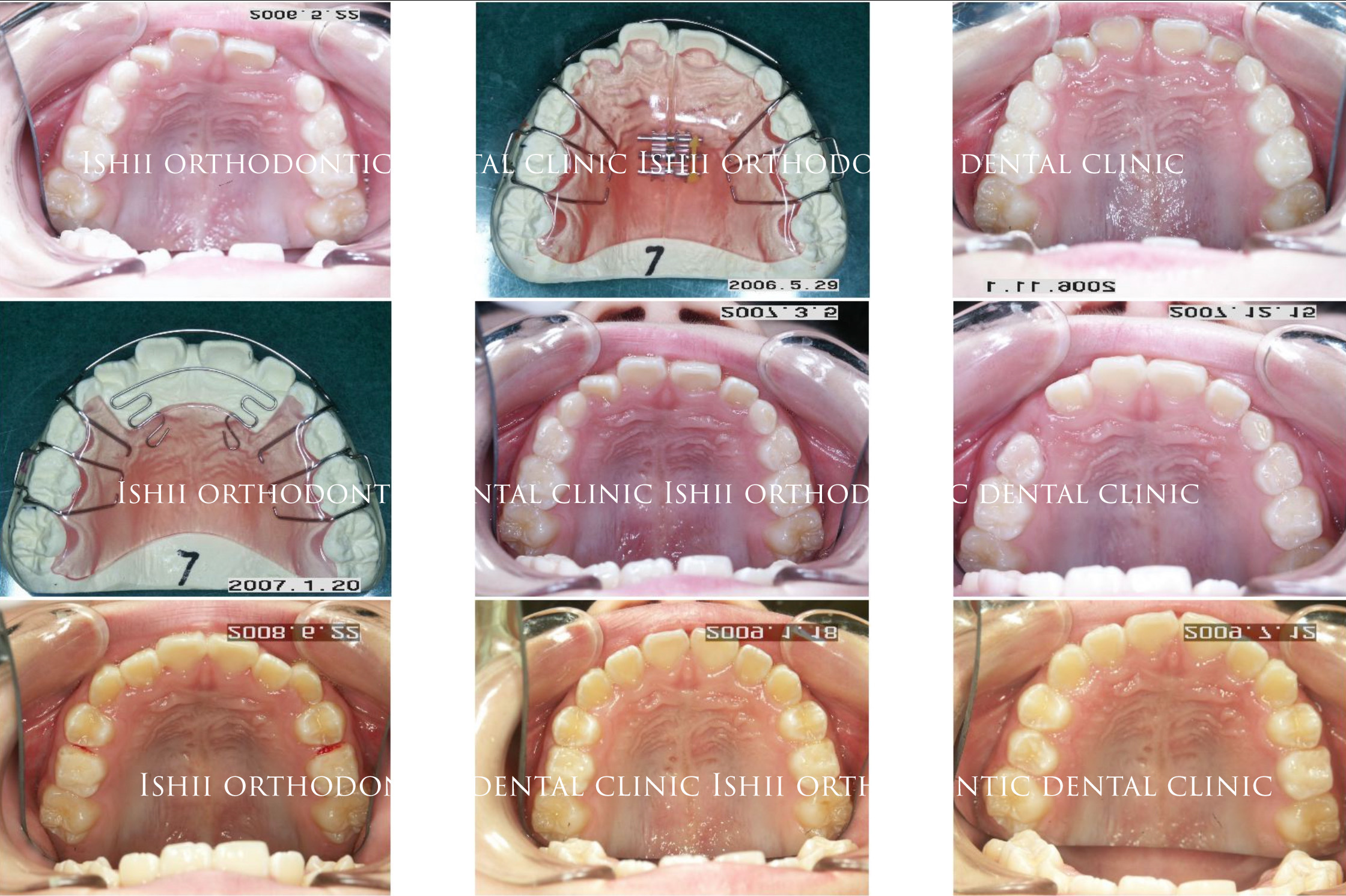 八重歯を簡単に治す方法について Album 199 石井歯科矯正歯科医院