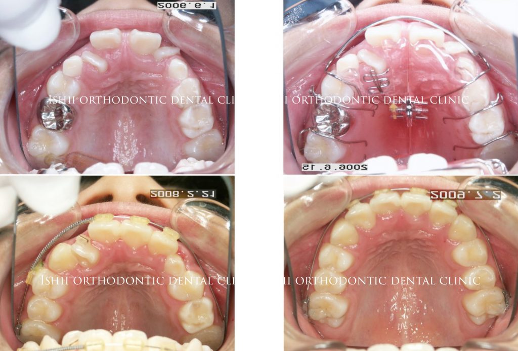 上の前歯 側切歯 が変なところからねじれて出た来た小学校4年生 Album 197 石井歯科矯正歯科医院