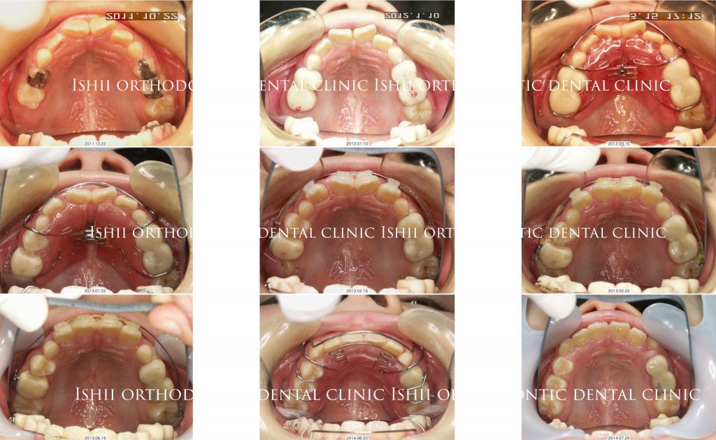 混合歯列期の矯正治療-