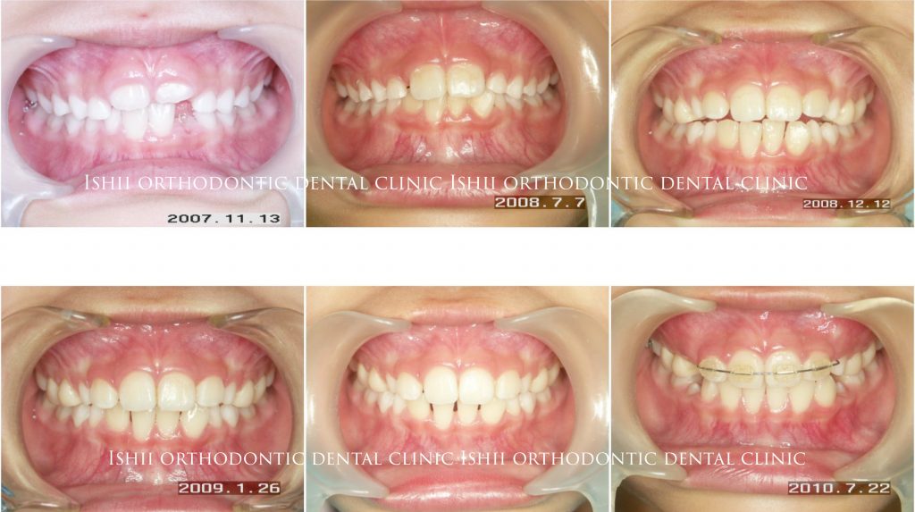 下の前歯 側切歯 がねじれて内側から出てきたことが心配で来院された小学校2年生の小児 Album 196 石井歯科矯正歯科医院
