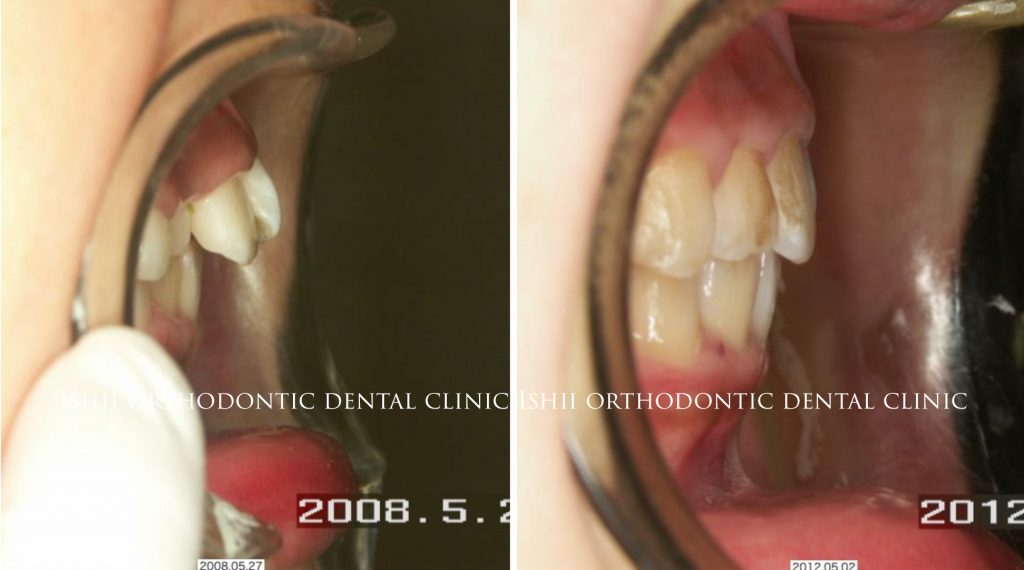 子供の出っ歯 上顎前突 で最も大切な事は顎を育てること Album 215 石井歯科矯正歯科医院