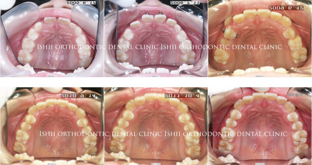 早期の小児矯正治療のメリットについて album 284 | 石井歯科矯正歯科医院