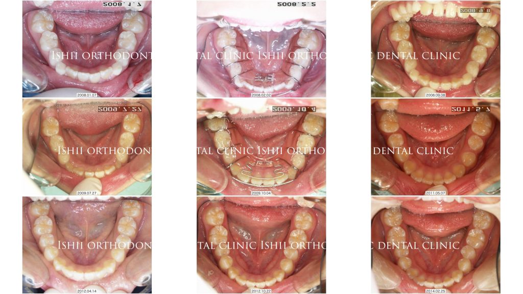 1期治療後の咬合誘導・咬合育成について 【album 329】 | 石井歯科矯正 