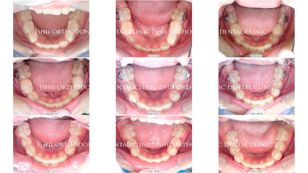 下顎両側側切歯の先天性欠損症例を非抜歯で改善する方法【album 380 